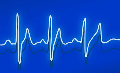 Identificat un mecanisme molecular que causa un tipus d'arítmia cardíaca greu