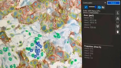 Visualització d'una mostra histopatològica analitzada pels algorismes de DigiPatICS. Autoria: Vall d'Hebrón