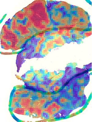 Imatge histopatològica de melanoma extreta durant una biòpsia cutània