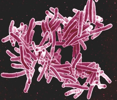 Tuberculosis has shaped human society since the Stone Age