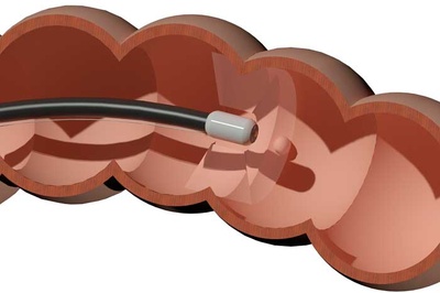 La revista 'Nature' selecciona a MiWEndo Solutions como finalista de un premio a las mejores 'spin-off'