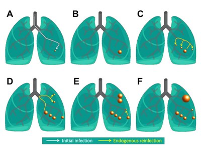 Un modelo computacional permite entender la dinámica de las lesiones dentro de los pulmones en las infecciones por tuberculosis