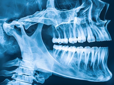Radiografía de una mandíbula